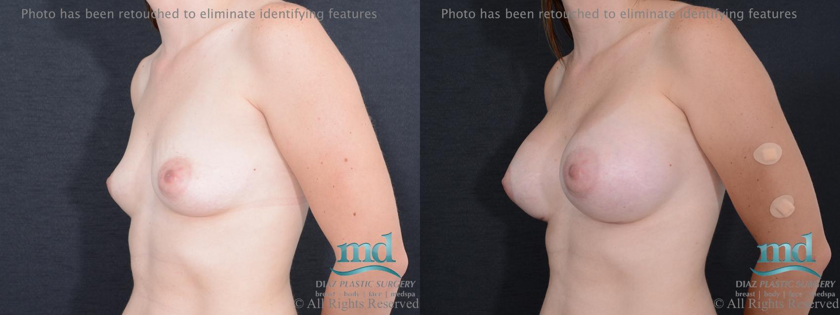 Before & After Breast Augmentation Case 53 View #4 View in Melbourne, FL