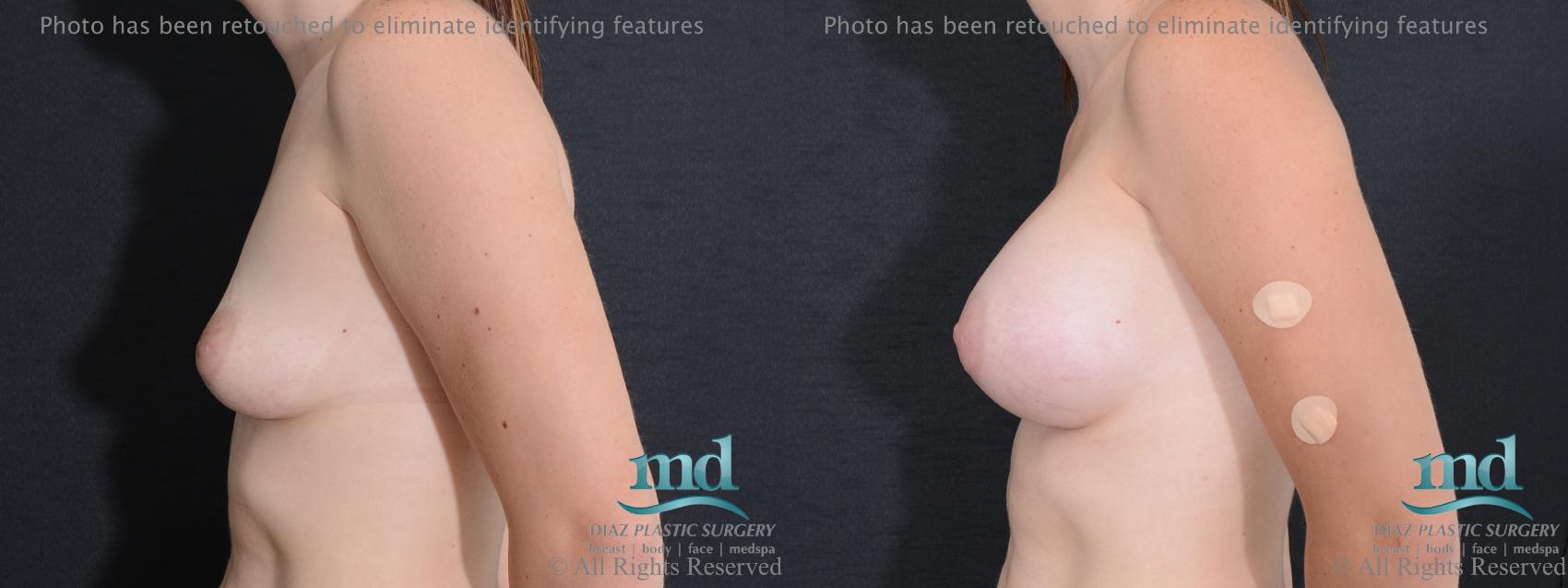 Before & After Breast Augmentation Case 53 View #5 View in Melbourne, FL