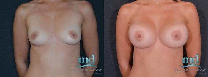 Before & After Breast Augmentation Case 54 View #1 View in Melbourne, FL