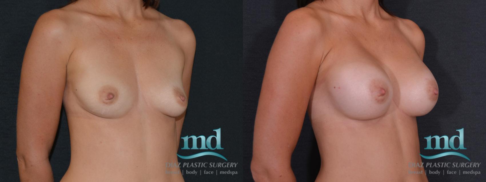 Before & After Breast Augmentation Case 54 View #2 View in Melbourne, FL