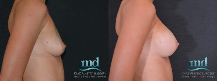 Before & After Breast Augmentation Case 54 View #3 View in Melbourne, FL