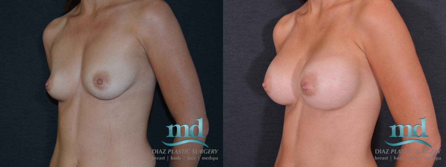 Before & After Breast Augmentation Case 54 View #4 View in Melbourne, FL