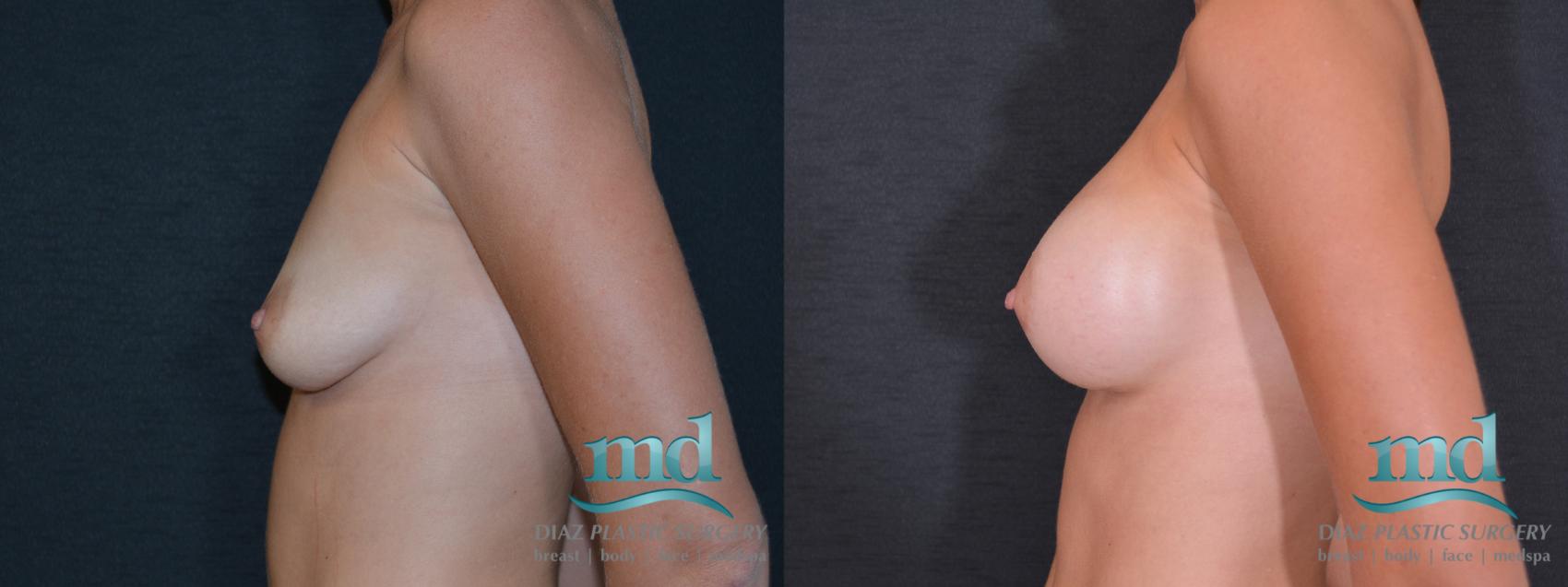 Before & After Breast Augmentation Case 54 View #5 View in Melbourne, FL
