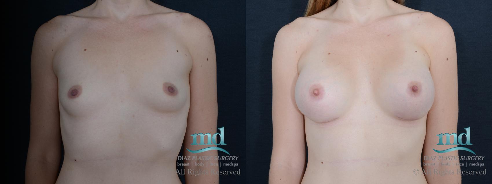 Before & After Breast Augmentation Case 55 View #1 View in Melbourne, FL