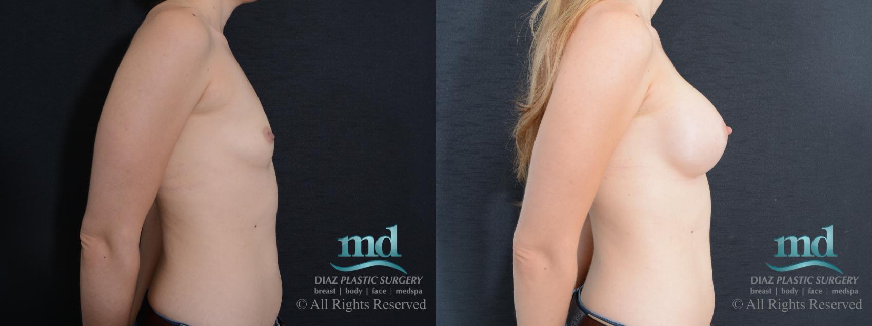 Before & After Breast Augmentation Case 55 View #3 View in Melbourne, FL