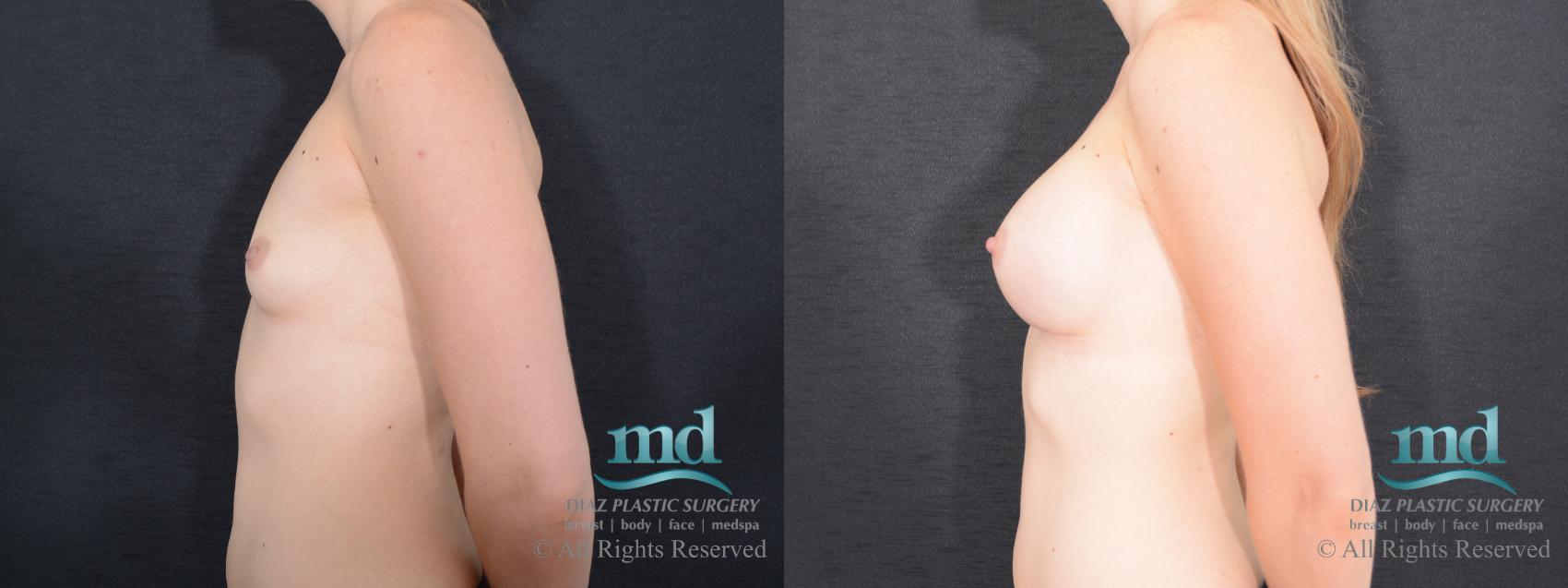 Before & After Breast Augmentation Case 55 View #5 View in Melbourne, FL