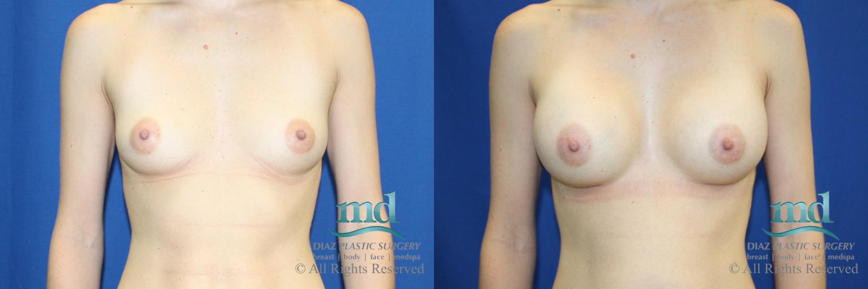 Before & After Breast Augmentation Case 56 View #1 View in Melbourne, FL