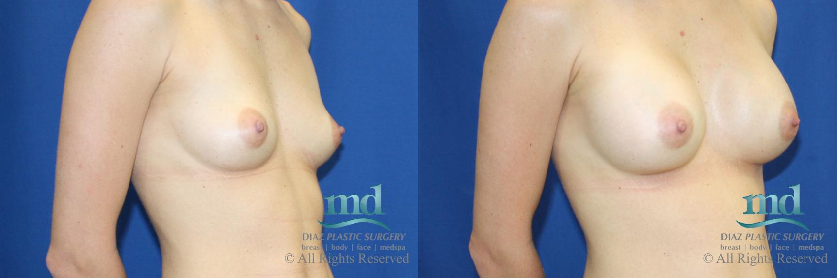 Before & After Breast Augmentation Case 56 View #2 View in Melbourne, FL