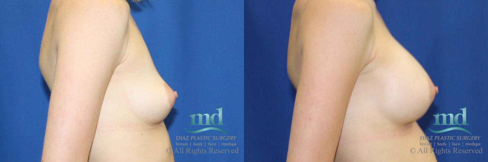 Before & After Breast Augmentation Case 56 View #3 View in Melbourne, FL