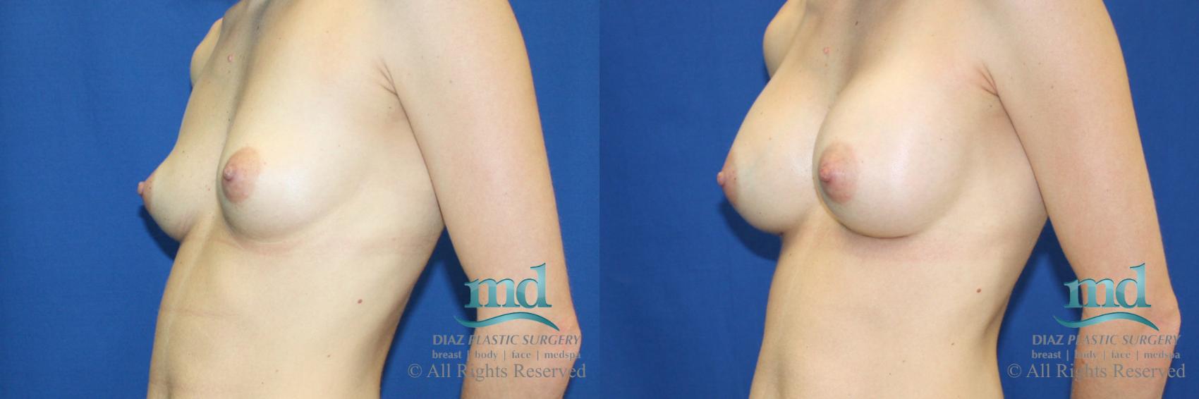 Before & After Breast Augmentation Case 56 View #4 View in Melbourne, FL