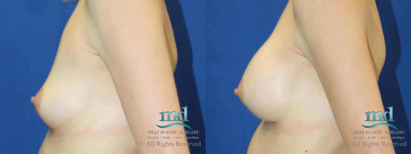Before & After Breast Augmentation Case 56 View #5 View in Melbourne, FL