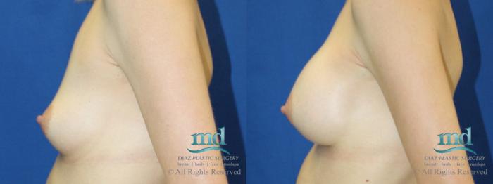 Before & After Breast Augmentation Case 56 View #5 View in Melbourne, FL