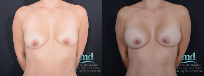 Before & After Breast Augmentation Case 57 View #1 View in Melbourne, FL