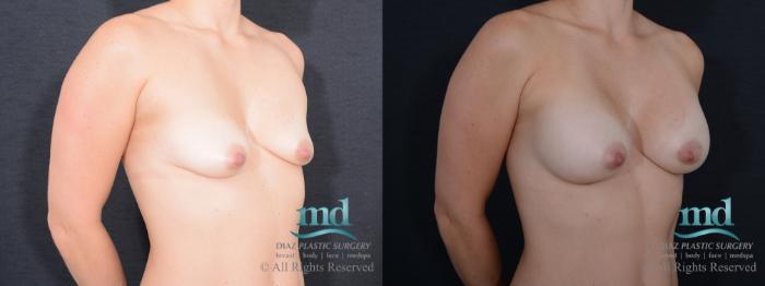 Before & After Breast Augmentation Case 57 View #2 View in Melbourne, FL