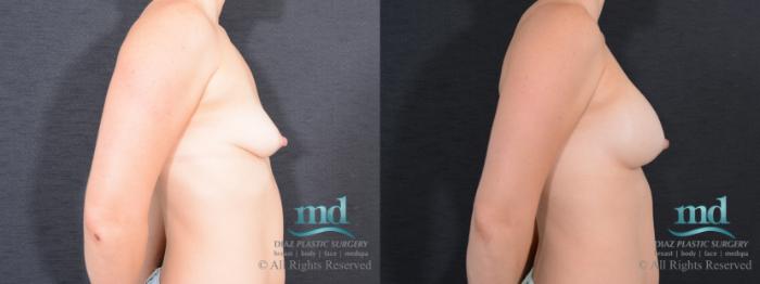 Before & After Breast Augmentation Case 57 View #3 View in Melbourne, FL