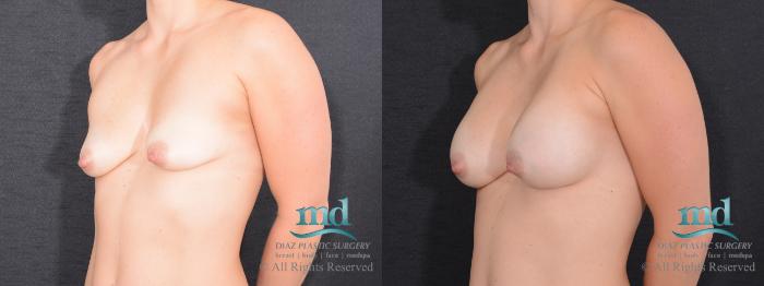 Before & After Breast Augmentation Case 57 View #4 View in Melbourne, FL