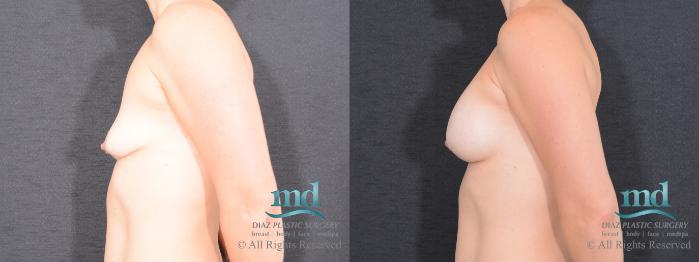 Before & After Breast Augmentation Case 57 View #5 View in Melbourne, FL