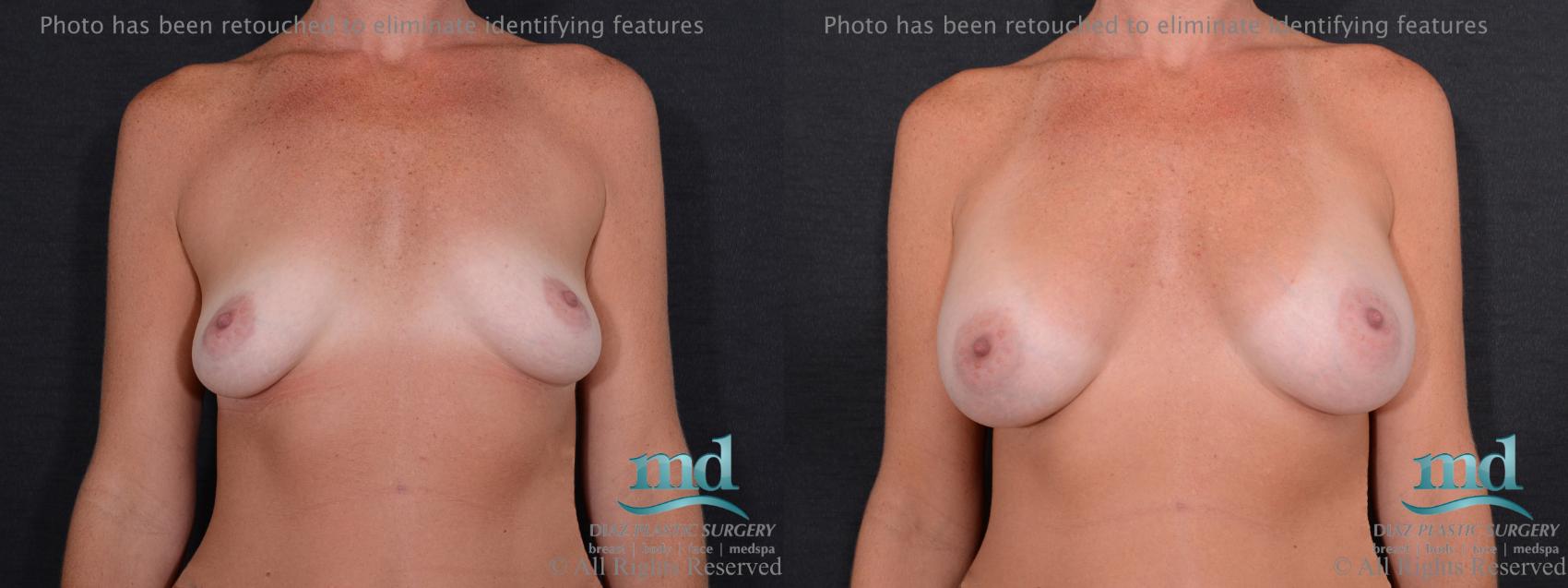 Before & After Breast Augmentation Case 58 View #1 View in Melbourne, FL