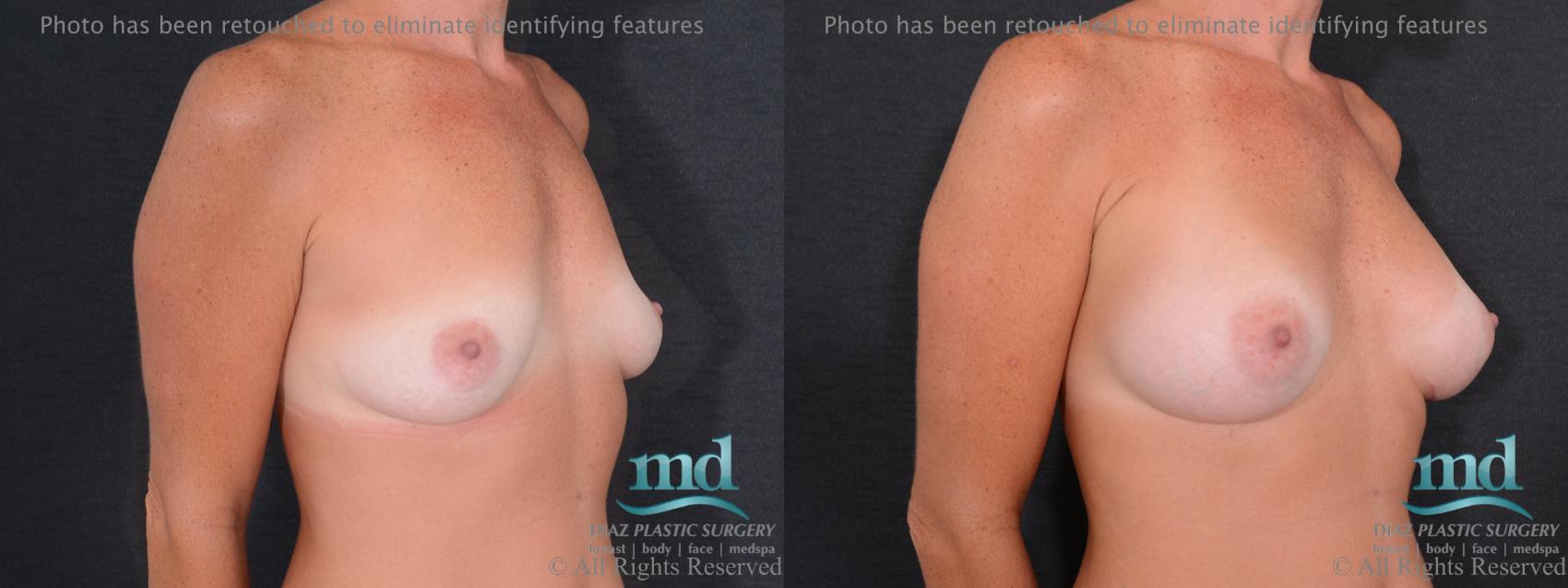 Before & After Breast Augmentation Case 58 View #2 View in Melbourne, FL