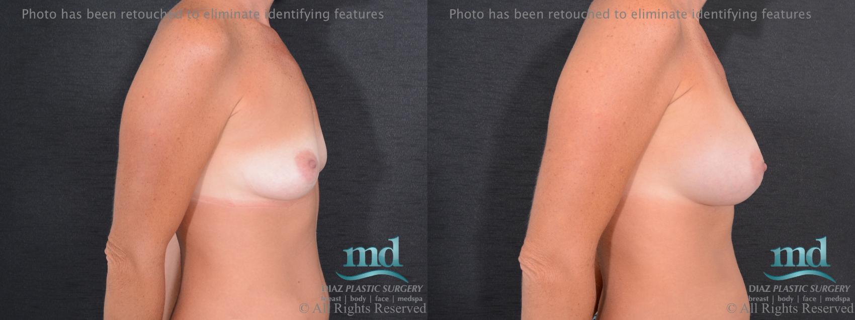 Before & After Breast Augmentation Case 58 View #3 View in Melbourne, FL