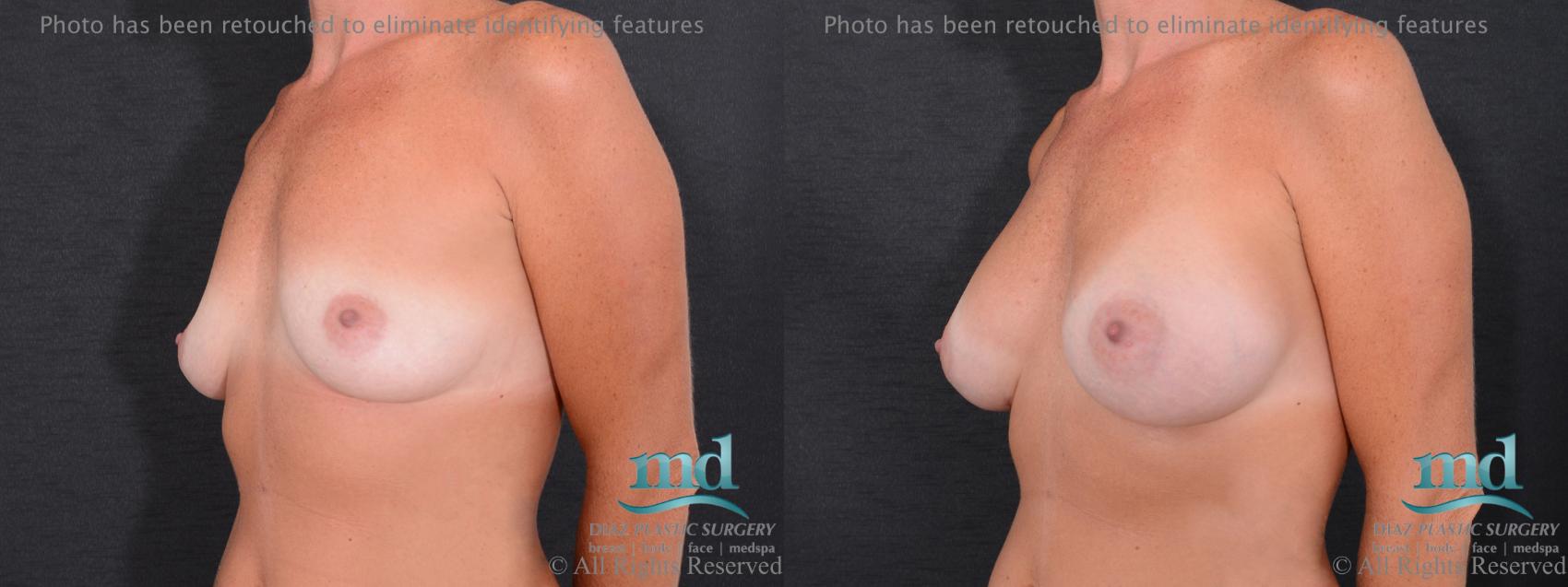 Before & After Breast Augmentation Case 58 View #4 View in Melbourne, FL