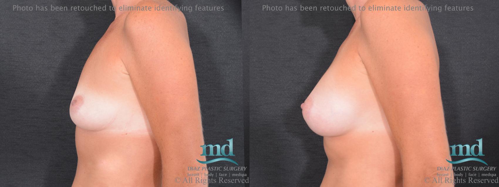 Before & After Breast Augmentation Case 58 View #5 View in Melbourne, FL