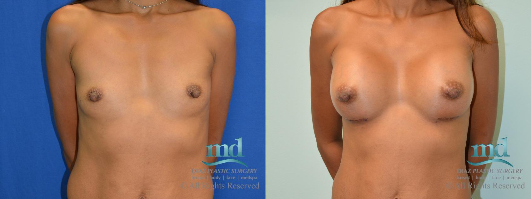 Before & After Breast Augmentation Case 59 View #1 View in Melbourne, FL
