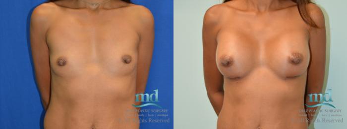 Before & After Breast Augmentation Case 59 View #1 View in Melbourne, FL
