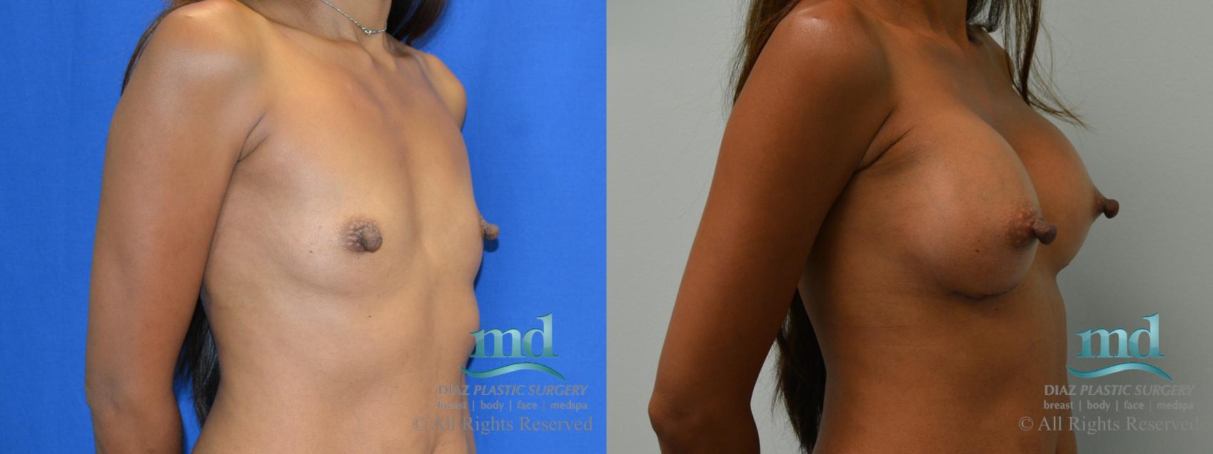 Before & After Breast Augmentation Case 59 View #2 View in Melbourne, FL