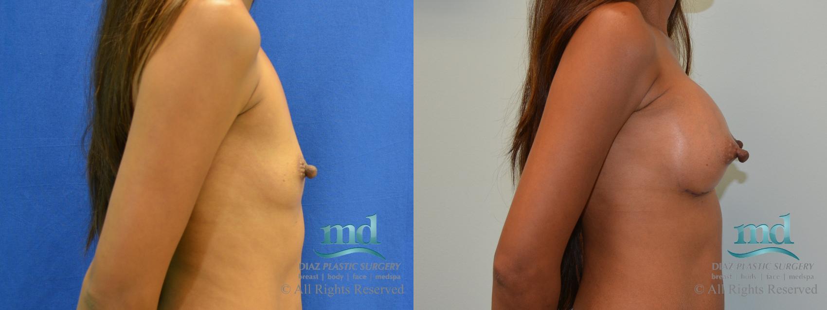 Before & After Breast Augmentation Case 59 View #3 View in Melbourne, FL