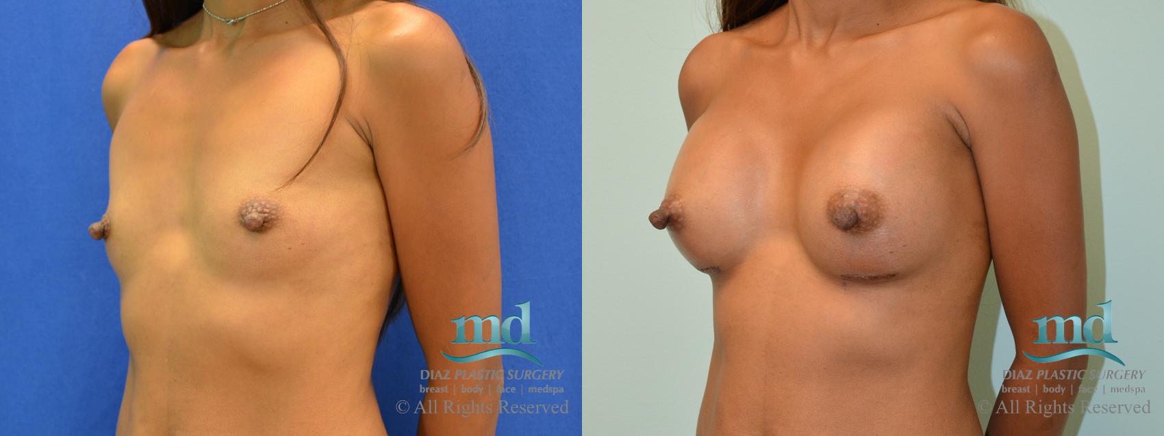 Before & After Breast Augmentation Case 59 View #4 View in Melbourne, FL