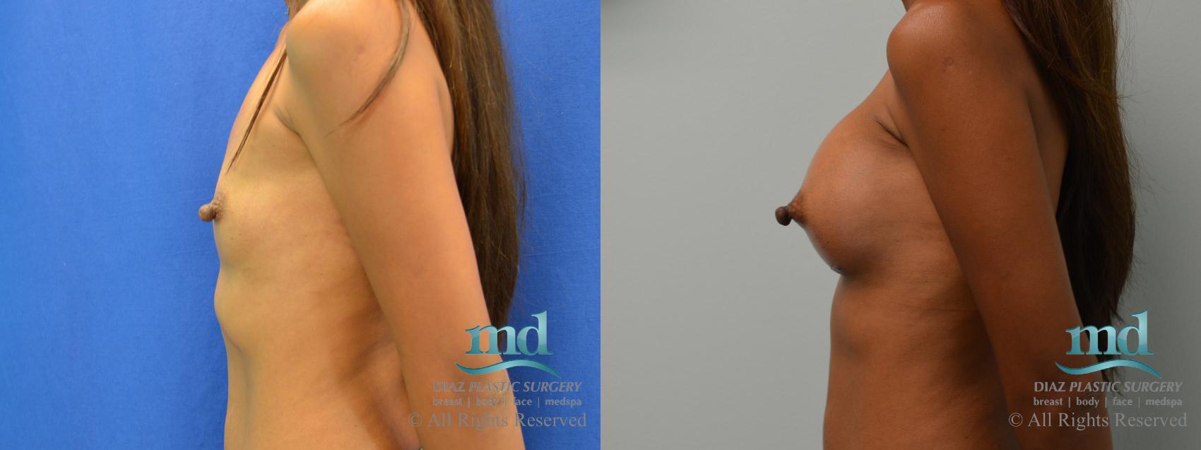 Before & After Breast Augmentation Case 59 View #5 View in Melbourne, FL