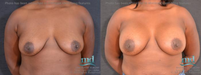 Before & After Breast Augmentation Case 60 View #1 View in Melbourne, FL