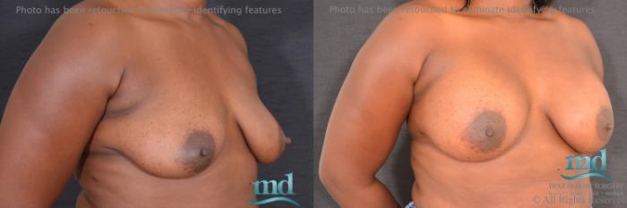 Before & After Breast Augmentation Case 60 View #2 View in Melbourne, FL