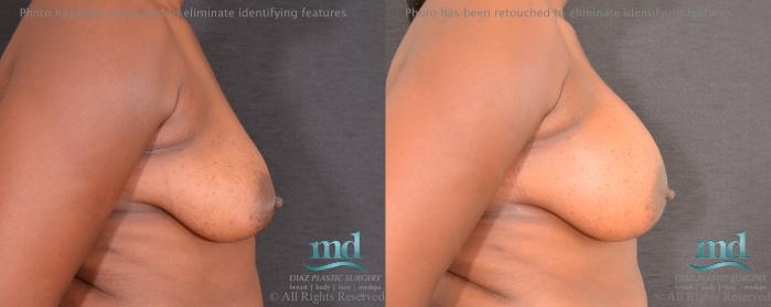 Before & After Breast Augmentation Case 60 View #3 View in Melbourne, FL