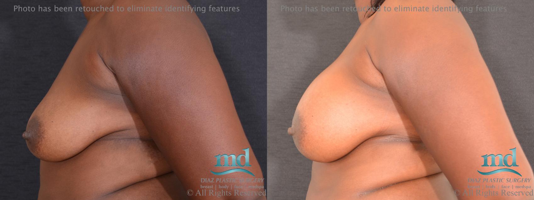 Before & After Breast Augmentation Case 60 View #5 View in Melbourne, FL