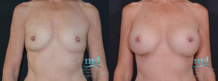 Before & After Breast Augmentation Case 61 View #1 View in Melbourne, FL