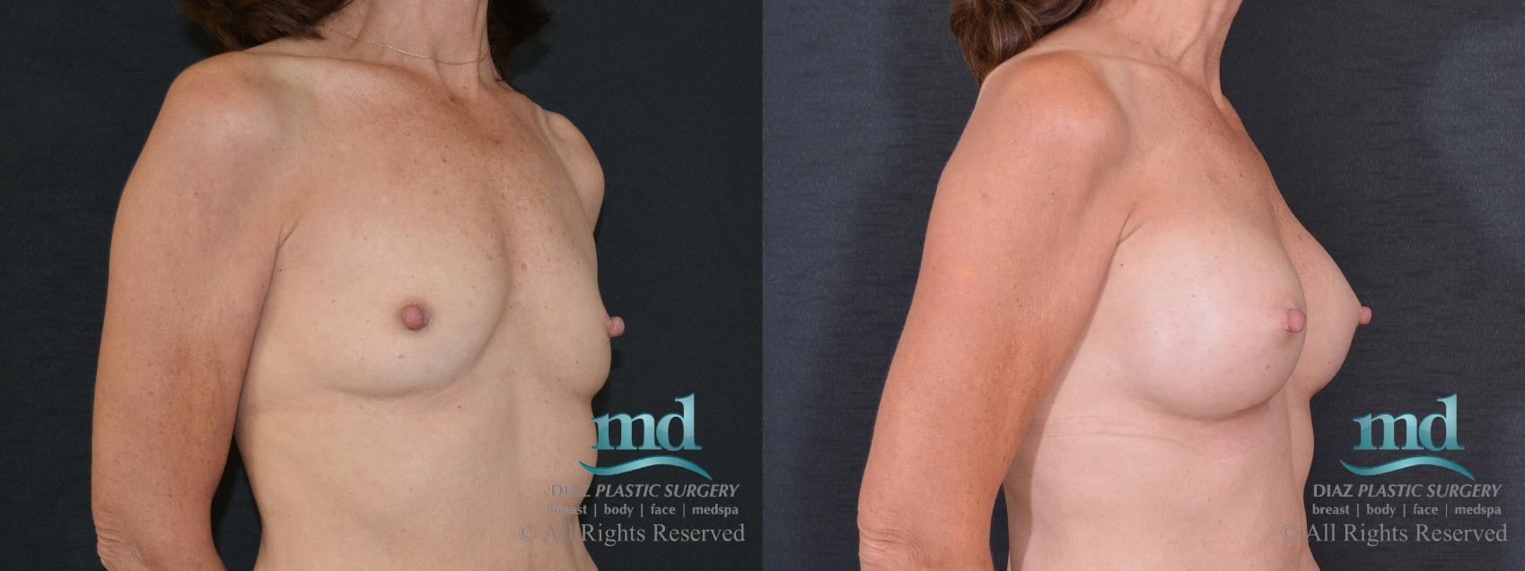Before & After Breast Augmentation Case 61 View #2 View in Melbourne, FL
