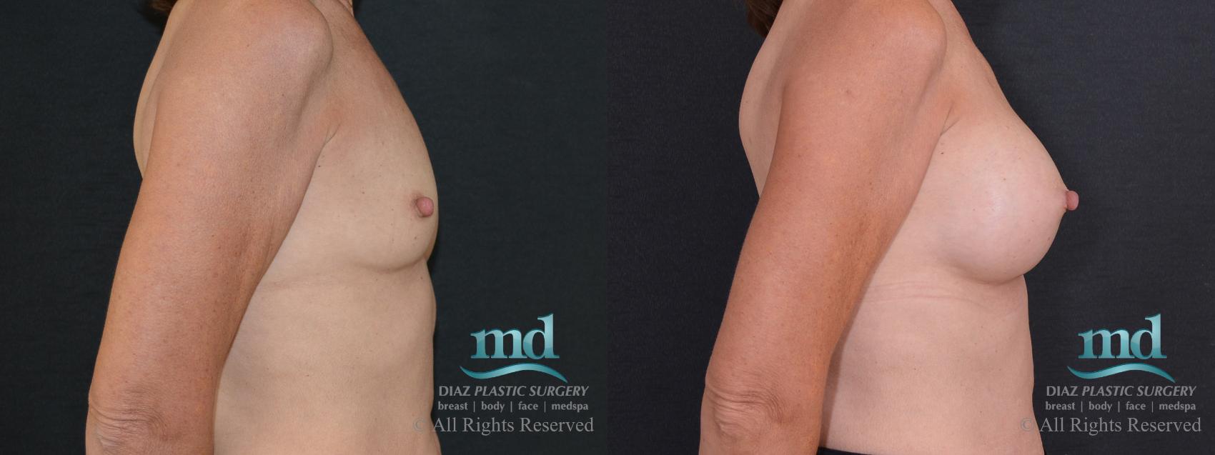 Before & After Breast Augmentation Case 61 View #3 View in Melbourne, FL