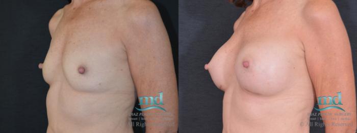 Before & After Breast Augmentation Case 61 View #4 View in Melbourne, FL