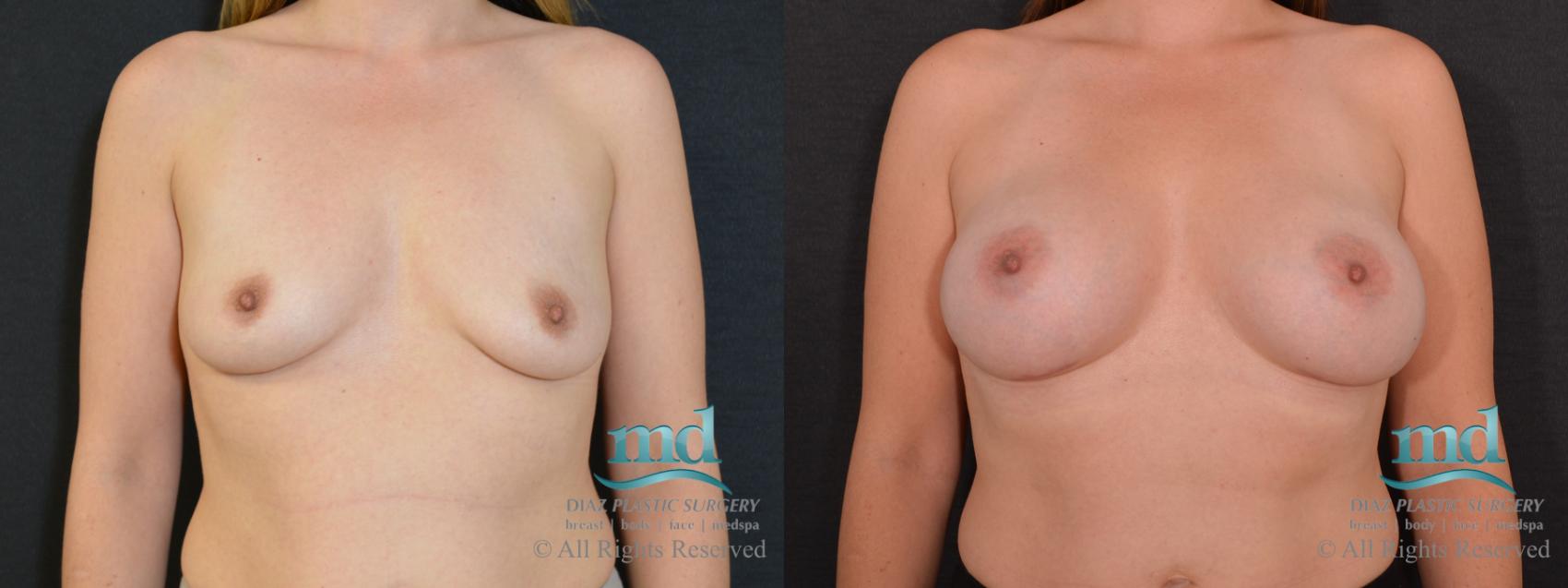 Before & After Breast Augmentation Case 62 View #1 View in Melbourne, FL