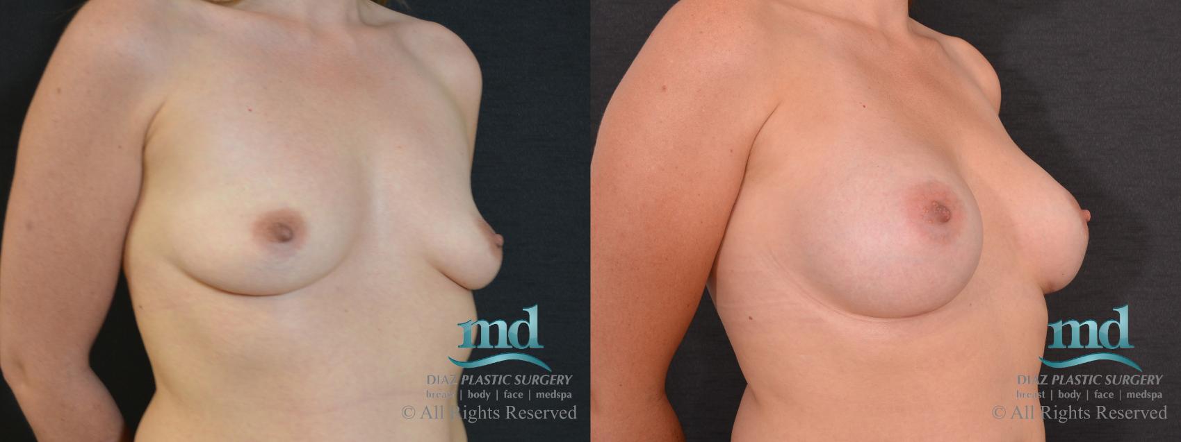 Before & After Breast Augmentation Case 62 View #2 View in Melbourne, FL