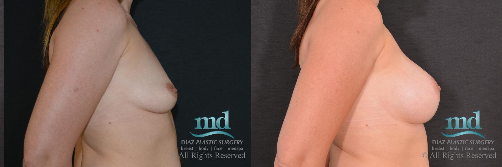 Before & After Breast Augmentation Case 62 View #3 View in Melbourne, FL