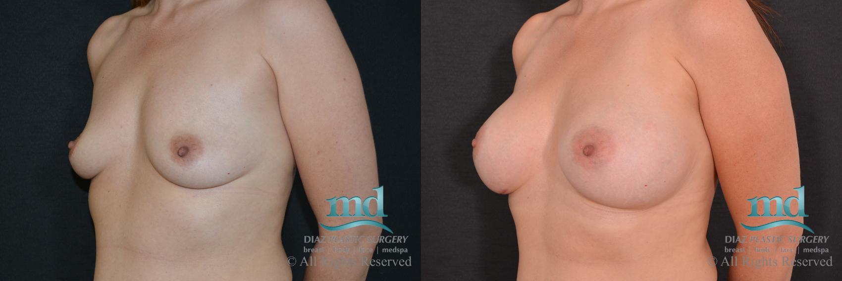 Before & After Breast Augmentation Case 62 View #4 View in Melbourne, FL