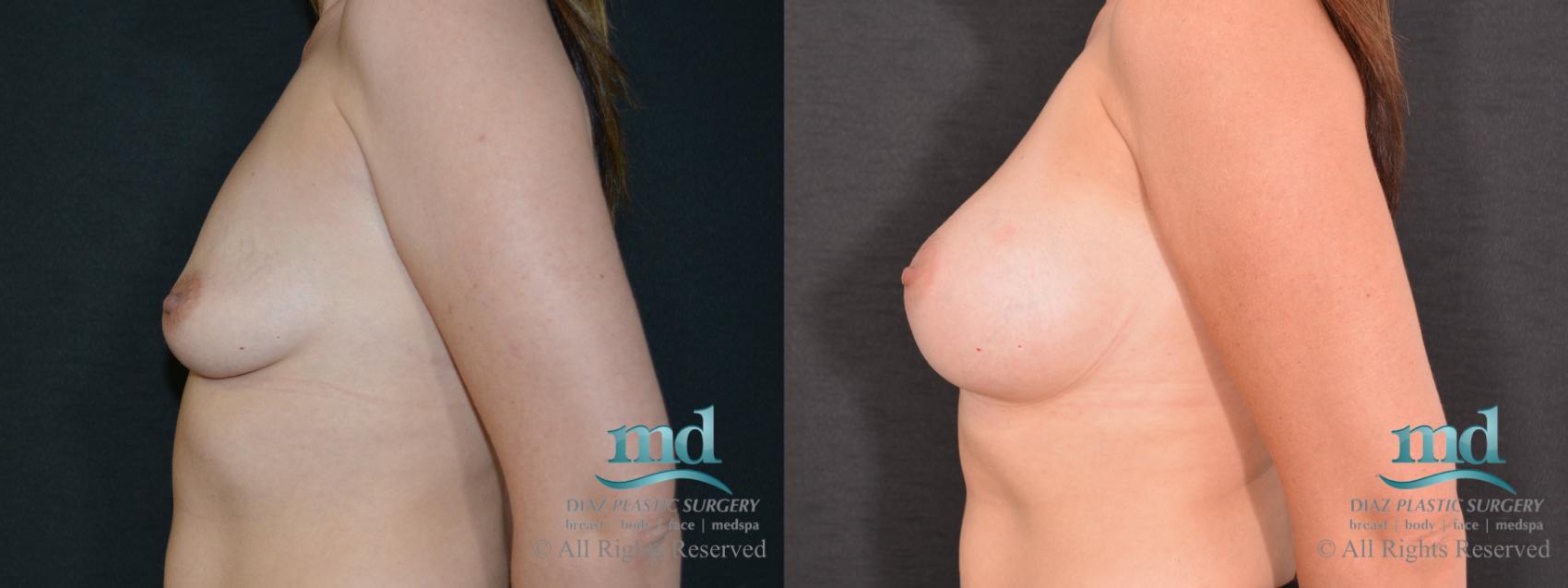 Before & After Breast Augmentation Case 62 View #5 View in Melbourne, FL