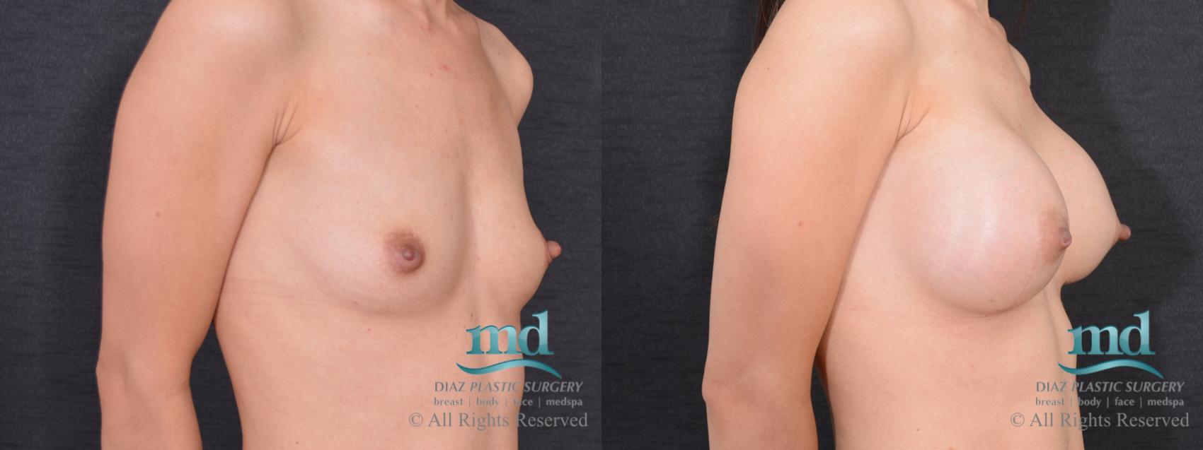 Before & After Breast Augmentation Case 63 View #2 View in Melbourne, FL
