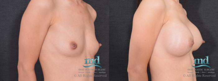 Before & After Breast Augmentation Case 63 View #2 View in Melbourne, FL