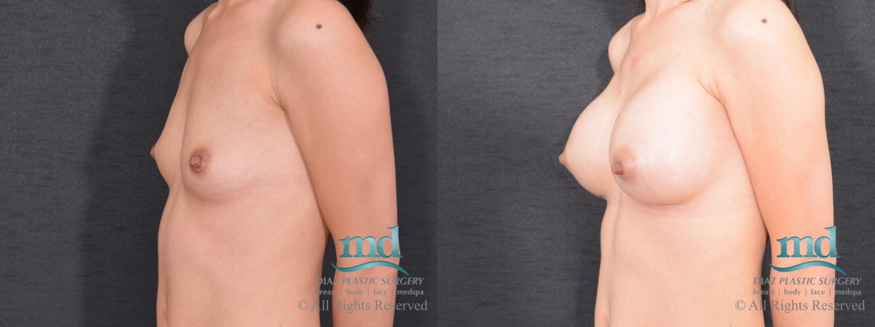Before & After Breast Augmentation Case 63 View #4 View in Melbourne, FL
