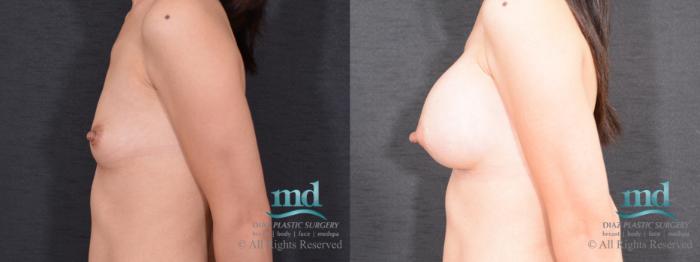 Before & After Breast Augmentation Case 63 View #5 View in Melbourne, FL