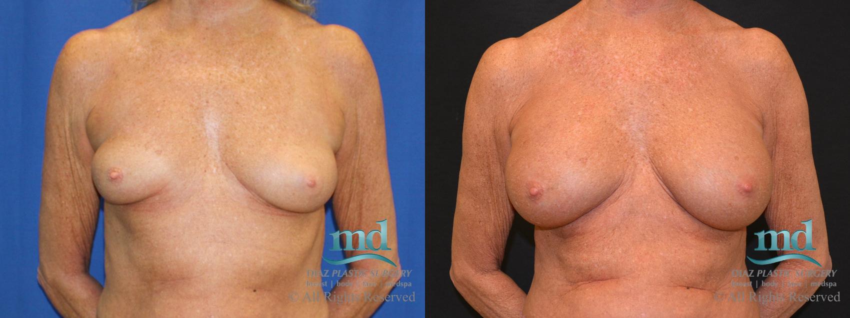 Before & After Breast Augmentation Case 64 View #1 View in Melbourne, Viera, Brevard County, FL